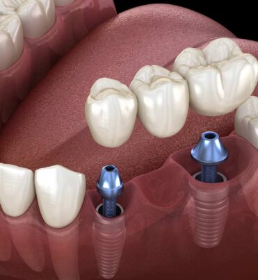 the-Difference-Between-Dental-Implants-and-Dental-Bridges the-Difference-Between-Dental-Implants-and-Dental-Bridges