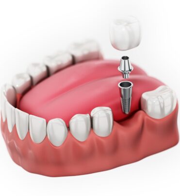 single-tooth-dental-implants-scaled single-tooth-dental-implants-scaled